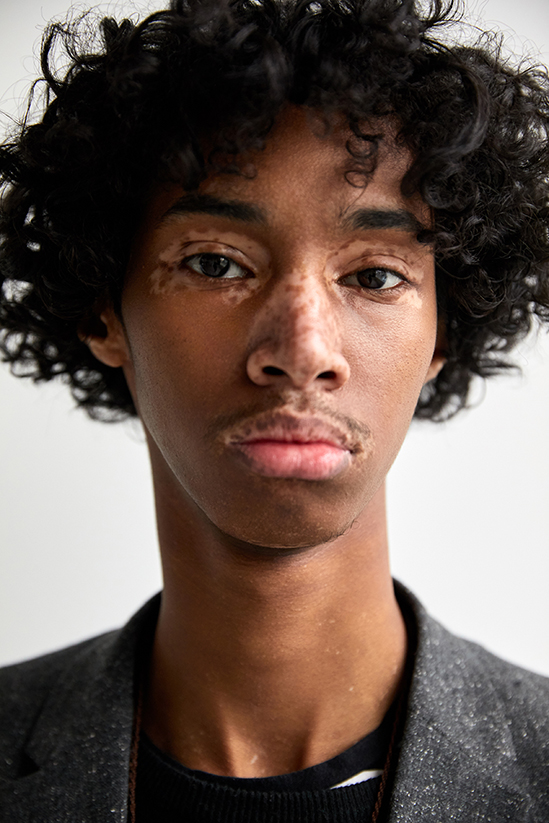 Portrait of a young man with vitiligo